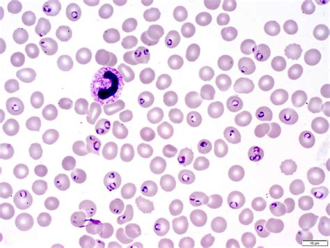  Falciparum Malaria Parasite: A Tiny Terror That Leaves a Massive Footprint!